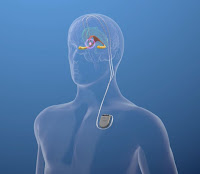 Image courtesy of Functional Neuromodulation Inc.
